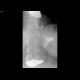 Carcinoma of oesophagus, stenosis: RF - Fluoroscopy
